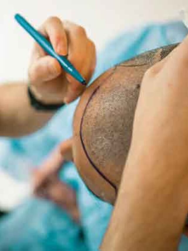 cropped-hair-transplant.jpg