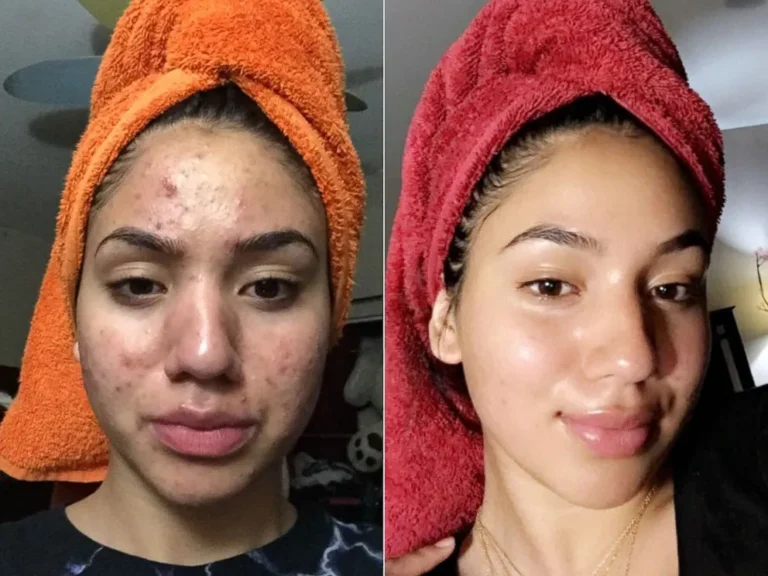 Before and after comparison showing acne reduction after using Vedantam Ayurveda herbal skincare products — face skin care Ghaziabad
