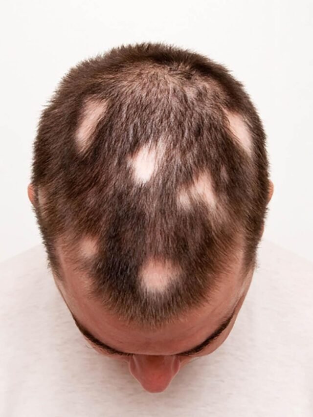 Ayurvedic Solutions for Hair Fall Treatment