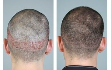 The Best hair loss clinic in Ghaziabad