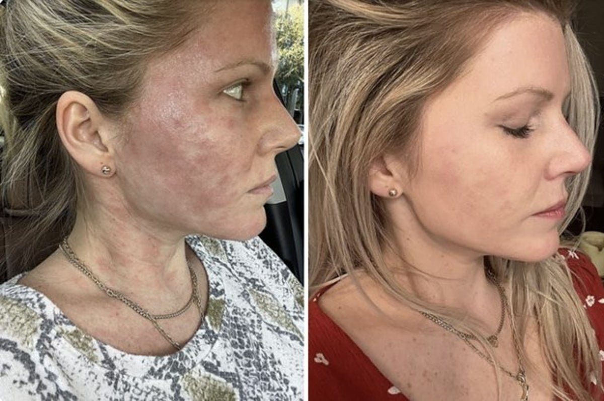 Before and after profile comparison showing reduced facial pigmentation and improved even skin tone with Vedantam Ayurveda products